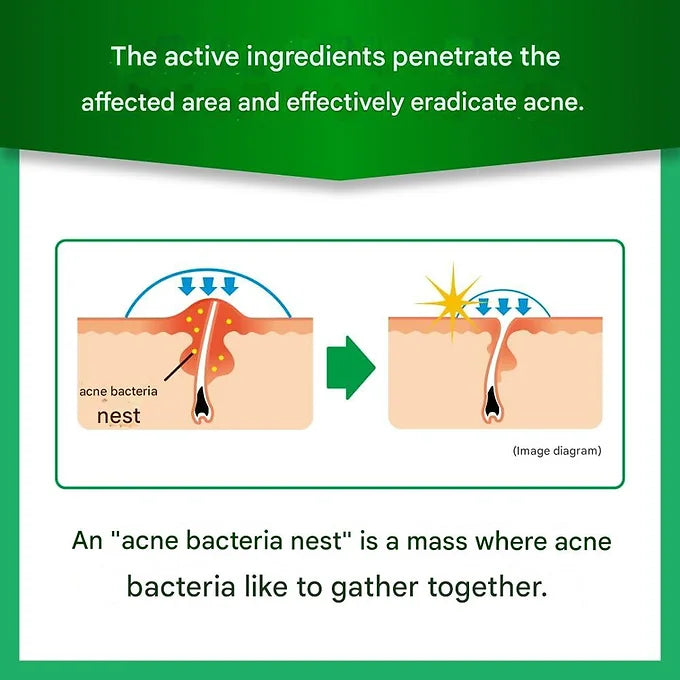 Mentholatum Acnes 25 Medical Mist b 100mL