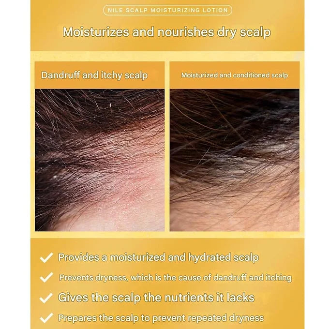 NILE Scalp Moisturizing Lotion Dandruff | Itchy | Dry Scalp Relief