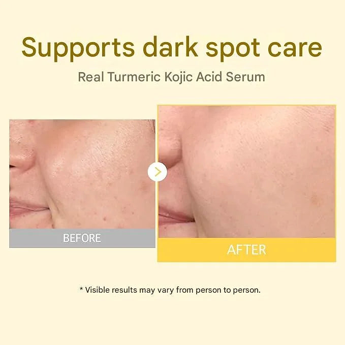 TOSOWOONG Real Turmeric Kojic Acid Serum – 1.1 fl oz (33 ml)